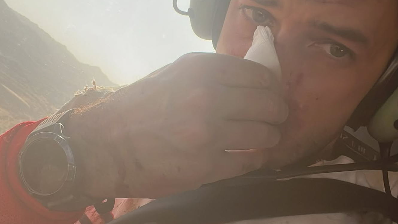 James Hillier with a broken nose on the 2025 Dakar Rally. Credit: Instagram/James Hillier.